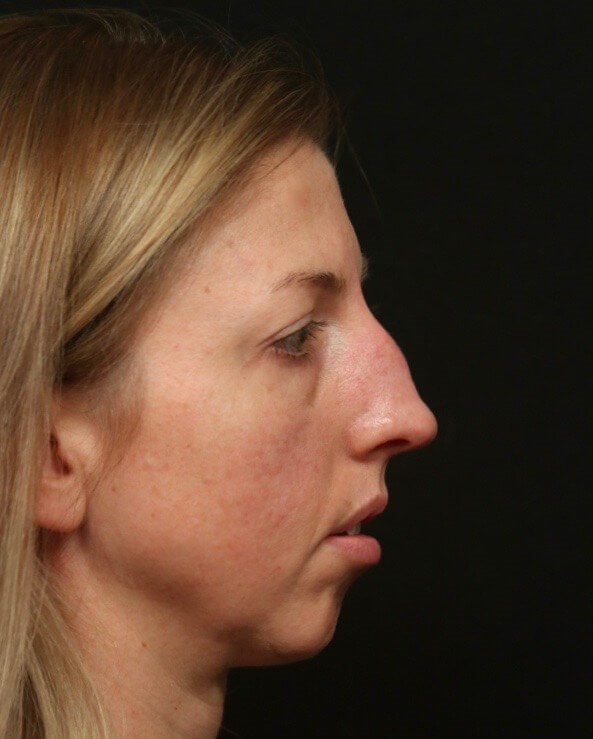 Rhinoplasty Before and After Before