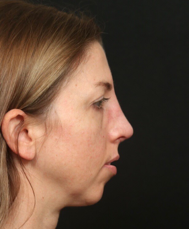 Rhinoplasty Before and After After
