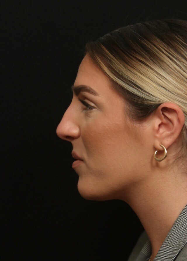 Septorhinoplasty Side View  Before