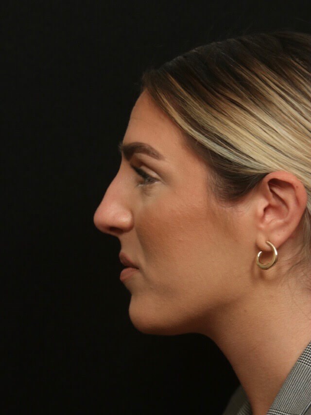 Septorhinoplasty Side View  Before