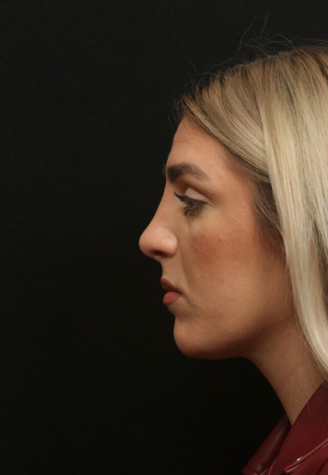 Septorhinoplasty Side View  After