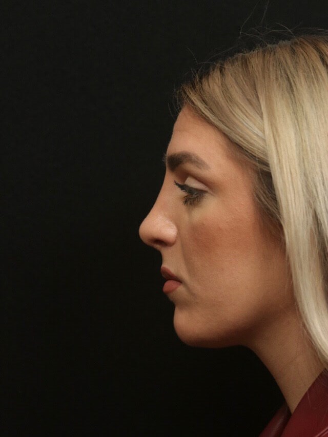 Septorhinoplasty Side View  After