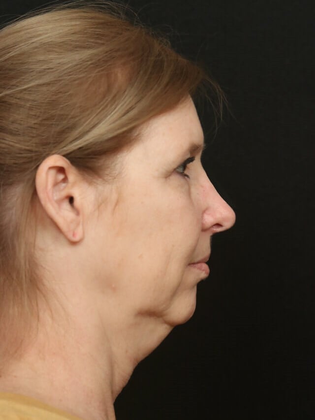 Before and After Facelift  Before