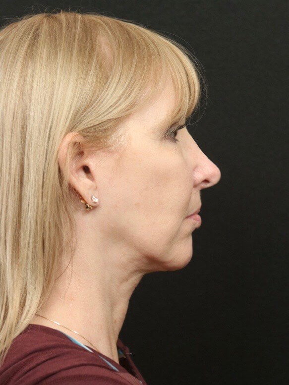 Before and After Facelift  After