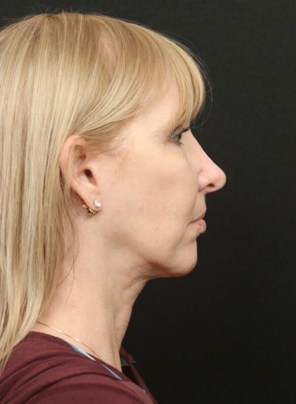 Before and After Facelift  After