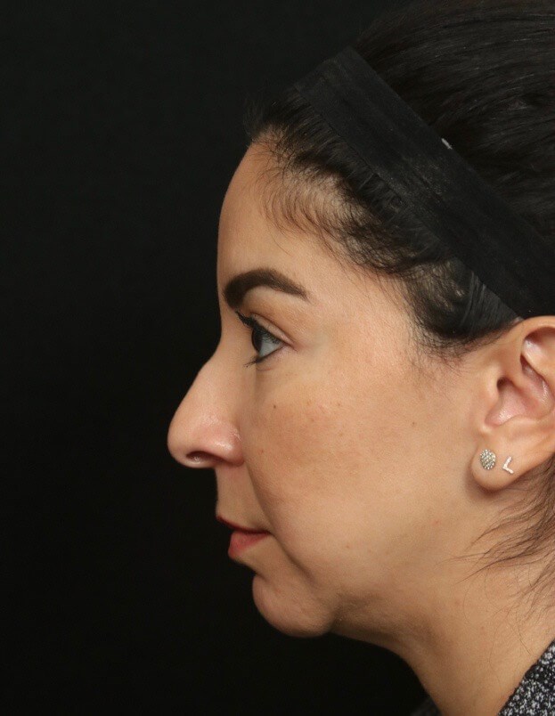 Rhinoplasty Before and After  Before