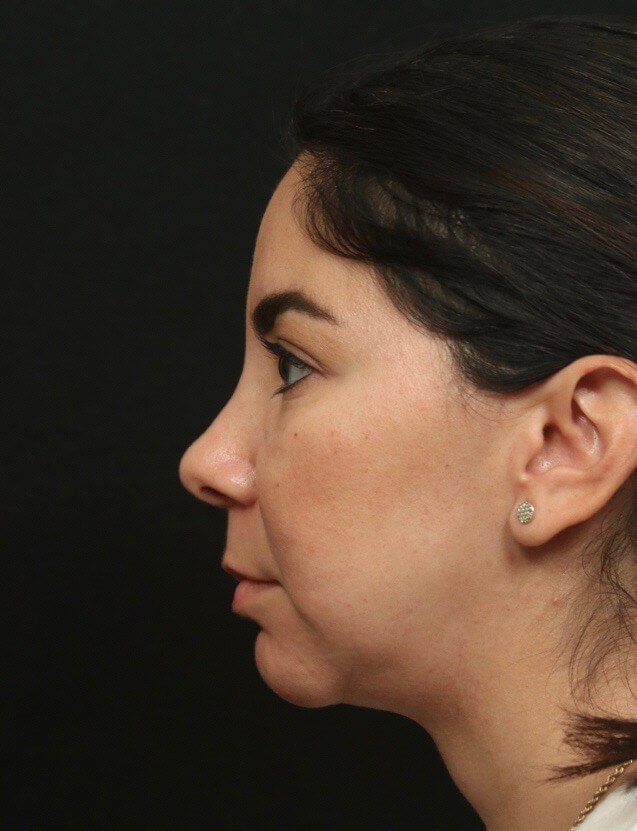 Rhinoplasty Before and After  After