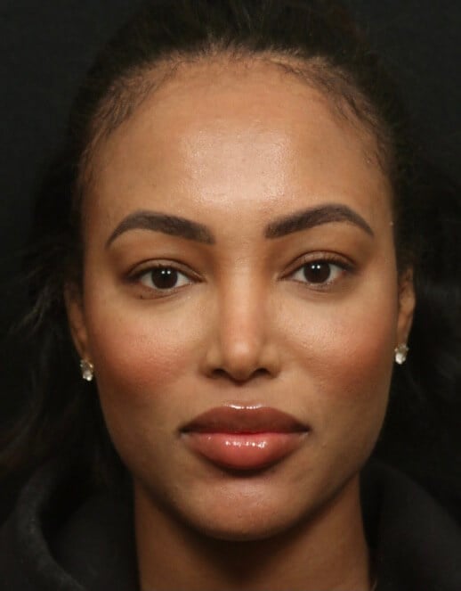 Ethnic Rhinoplasty on Dallas F After