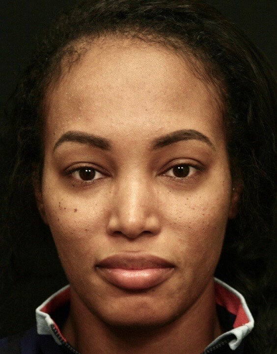 Ethnic Rhinoplasty on Dallas F Before