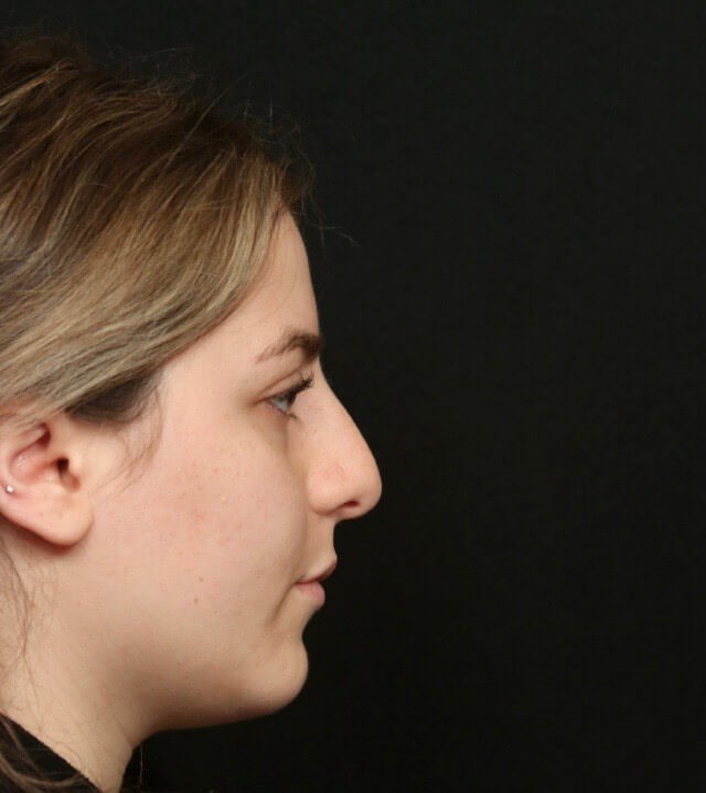 Rhinoplasty Side View Before
