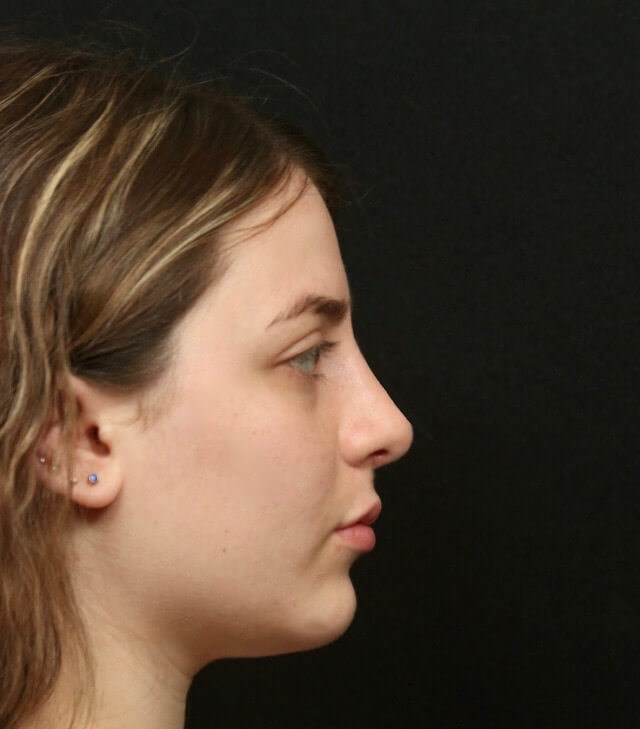 Rhinoplasty Side View After