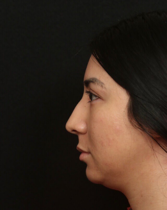 Rhinoplasty Before and After  Before
