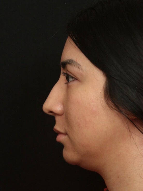 Rhinoplasty Before and After  Before