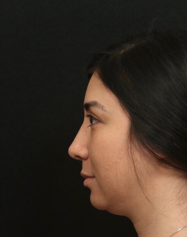 Rhinoplasty Before and After  After