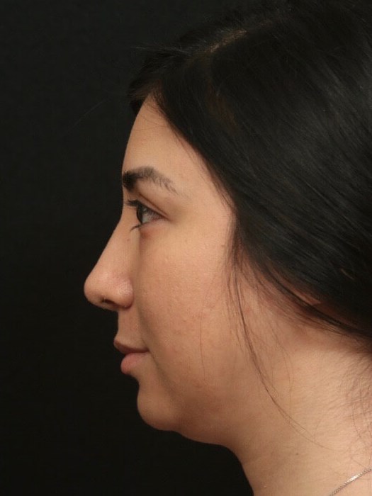 Rhinoplasty Before and After  After