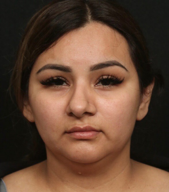 Before and After Front View Before