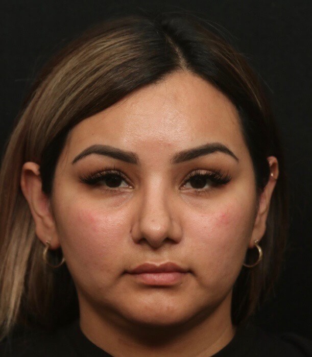 Before and After Front View After