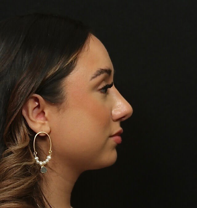 Before and After Rhinoplasty After