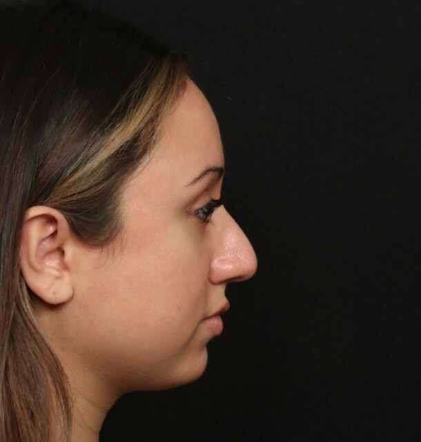 Before and After Rhinoplasty Before