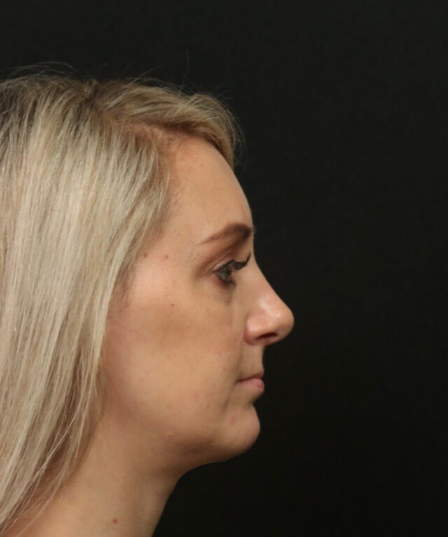 Rhinoplasty Side View After