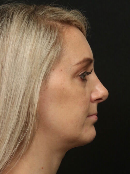 Rhinoplasty Side View After