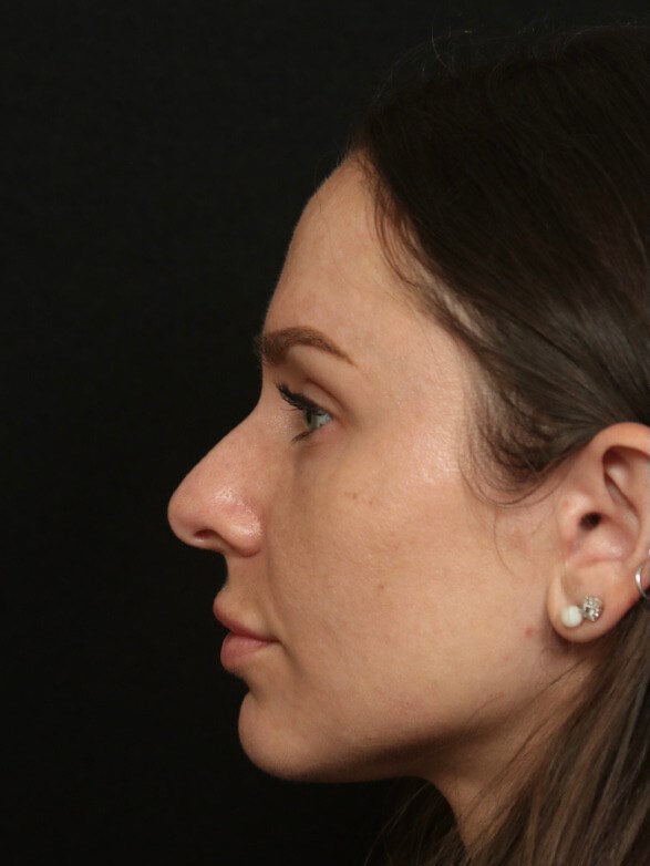 Rhinoplasty Before and After Before