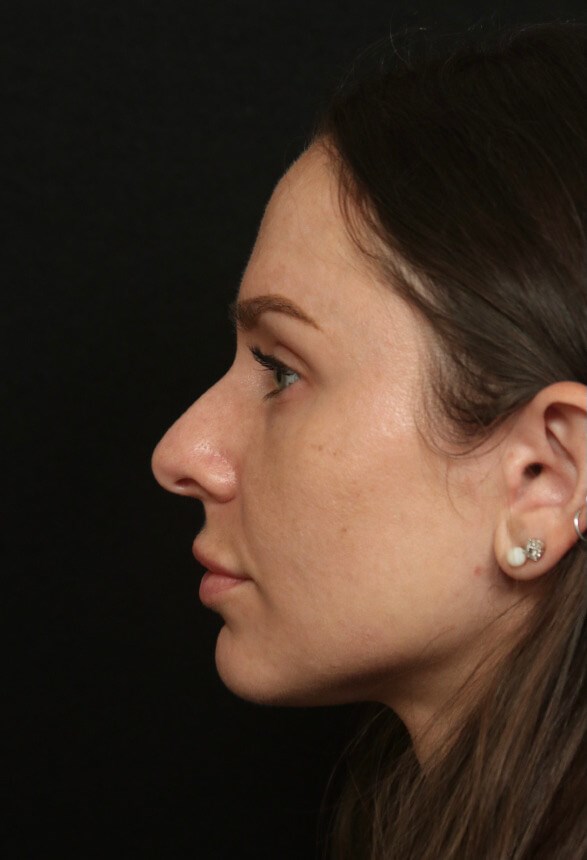 Rhinoplasty Before and After Before
