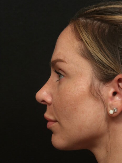 Rhinoplasty Before and After After