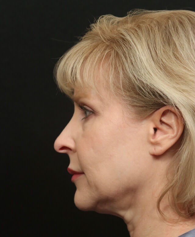 Rhinoplasty Before and After Before