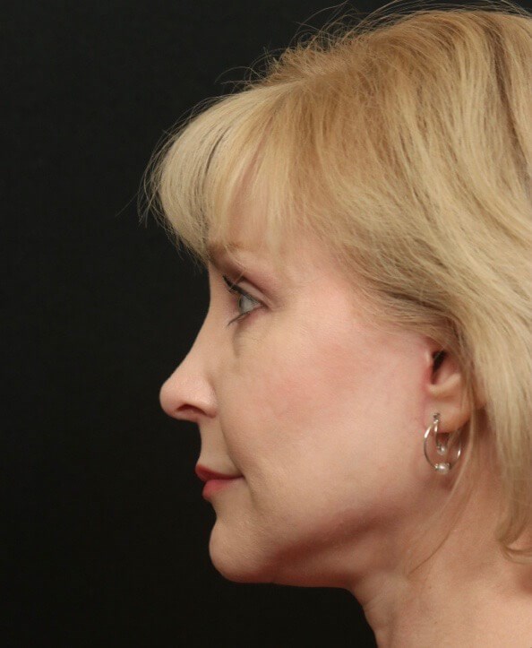 Rhinoplasty Before and After After