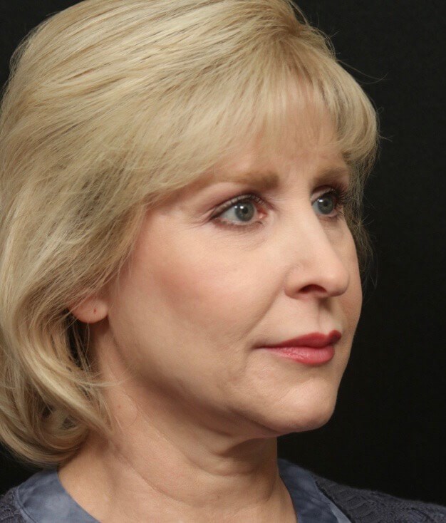 Facelift Before and After Before