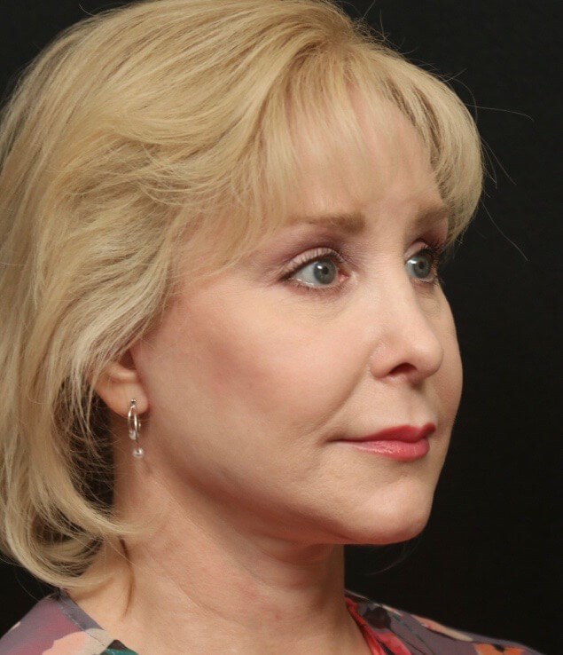 Facelift Before and After After