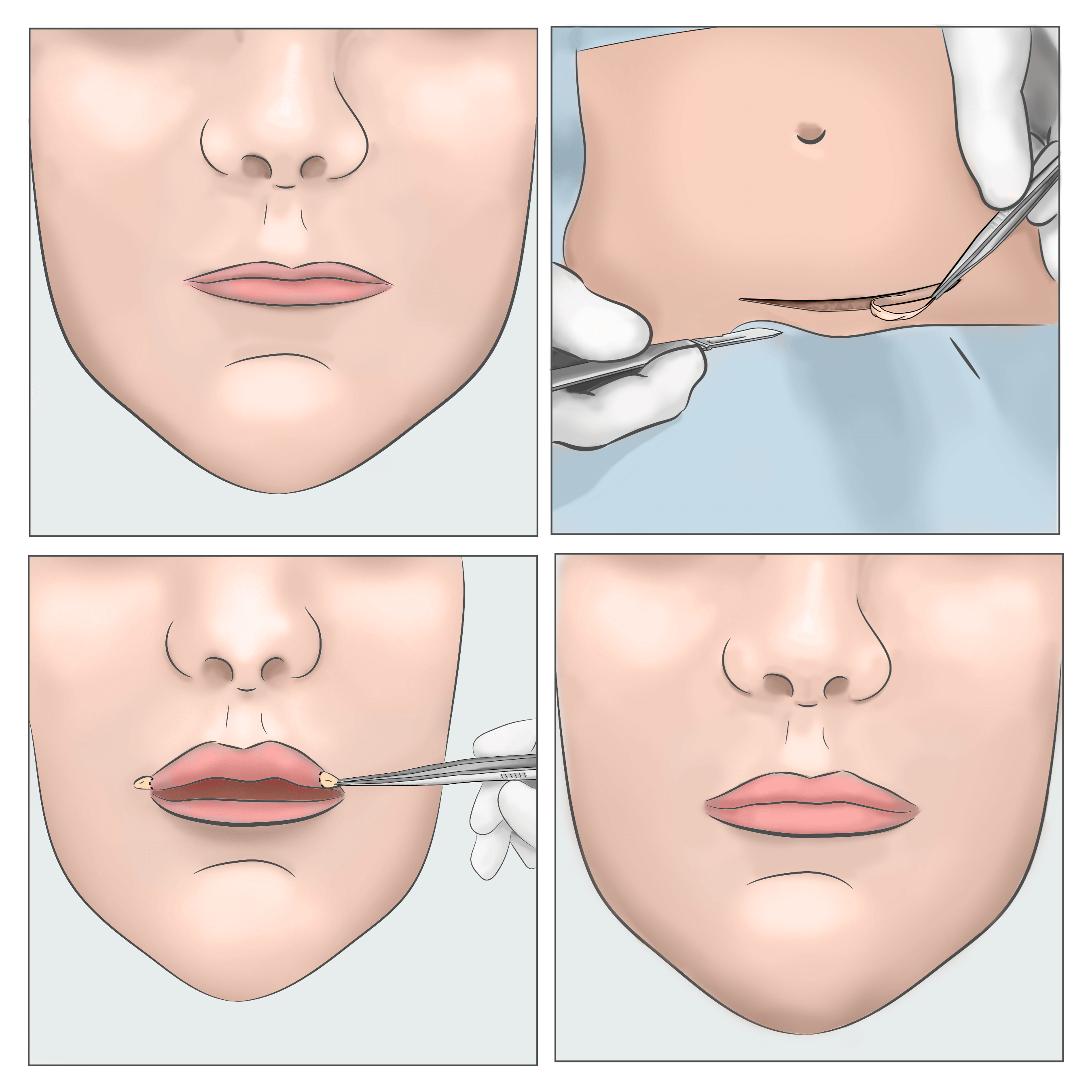 Lip Augmentation Procedure